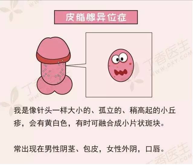 皮脂腺异位症系带旁丘疹,正如其名,就是长在系带两旁的珍珠疹,长了它