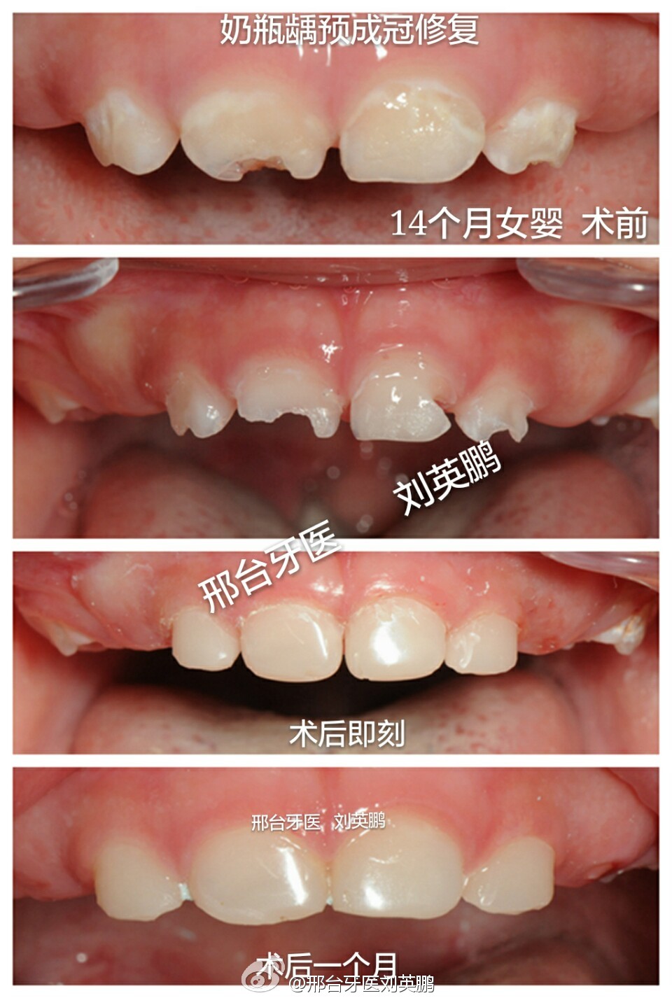 奶瓶龋是什么?怎么发生的?影响新牙吗?如何治疗?