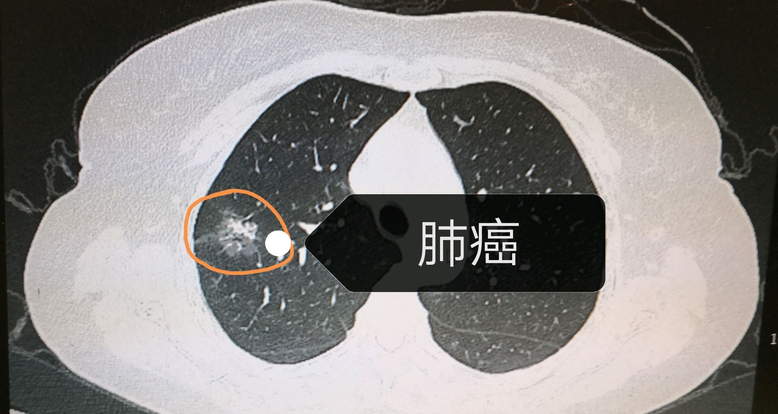 为什么胸片提示左肺炎症,ct却发现右肺癌?