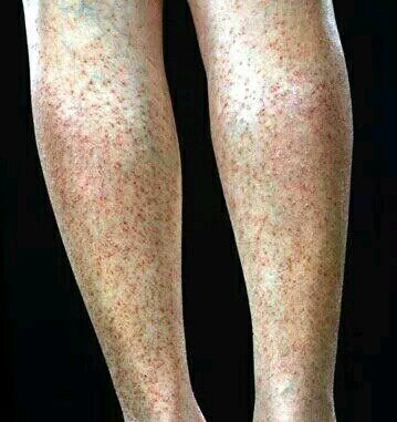 持久性豆状角化过度症