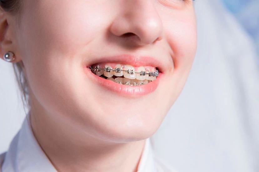适合的人群: 下兜齿 龅牙 牙列不齐 牙隙过大 双颌前突 咬合过深和