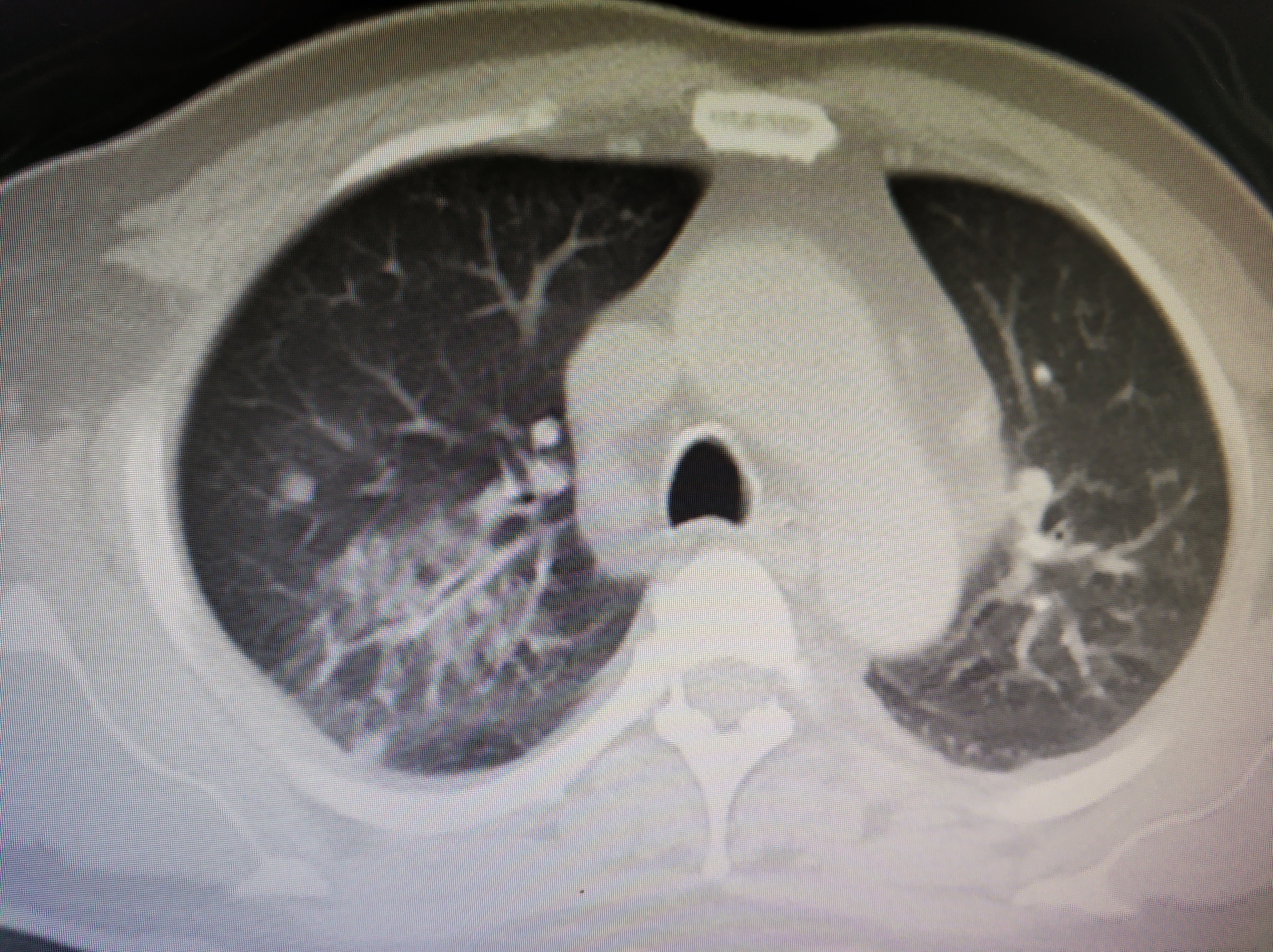 肺结核CT片图片