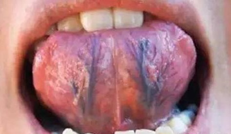 舌下出血点图片图片