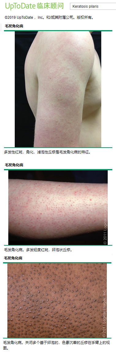 哪些疙疙瘩瘩的皮肤——鸡皮病-刘华主治医师-爱问医生