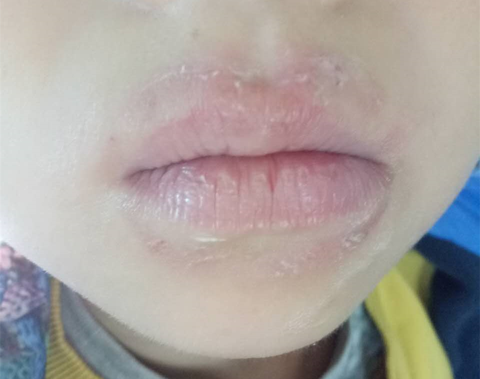 当心宝宝舔出来的皮肤病