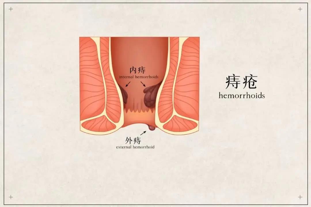 正确认识痔疮,这几点有助于治疗!