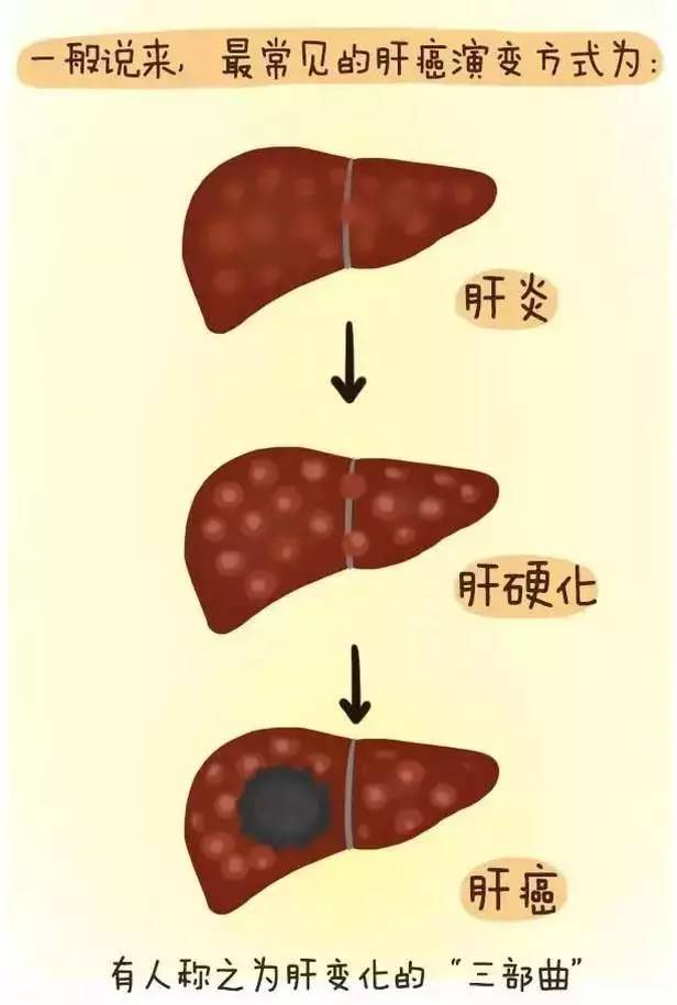 5肝癌