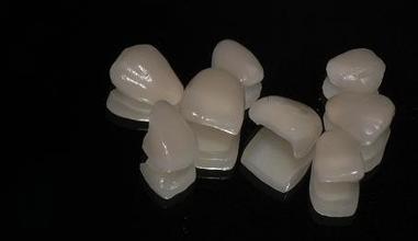 做瓷贴面要多久时间