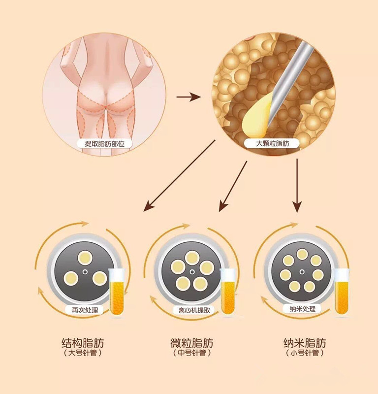 抽取,乳化处理后提取出体积功效各不同的结构脂肪,微粒脂肪和纳米脂肪