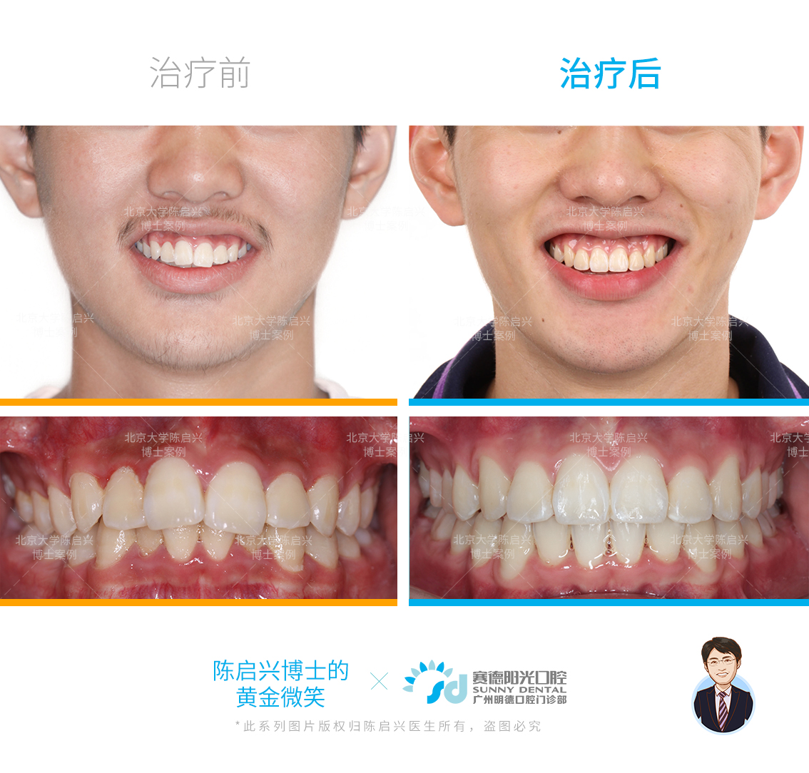 腺样体面容 兔牙 深覆盖矫正案例