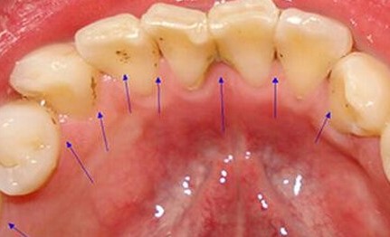 牙齿不齐除了发音问题,还会引发哪些危害?