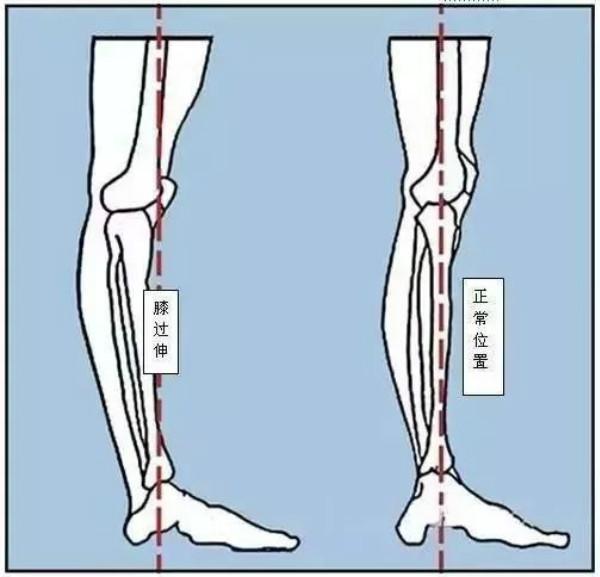 (七)踮脚尖(八)足内翻 足外翻(九)扭转痉挛