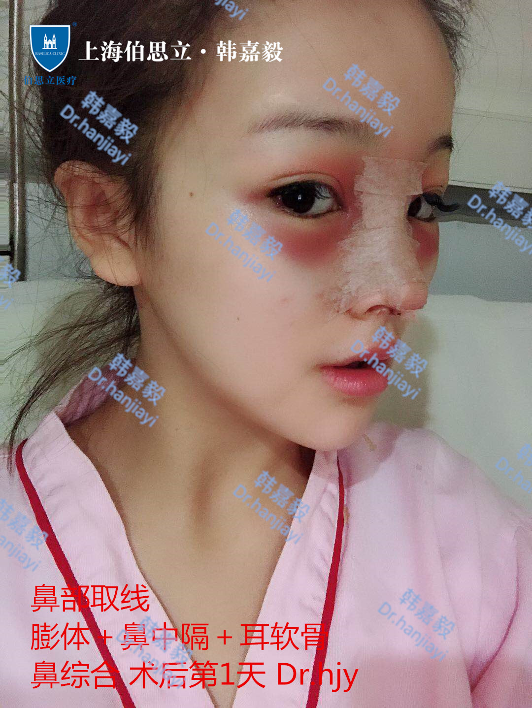 线雕隆鼻的危害你了解吗?