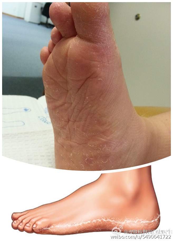 小真菌,大麻烦——什么是香港脚?