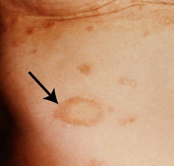 起始期: 典型皮疹为单一较大的,稍高出皮面的鳞屑斑,可累及胸腹部或