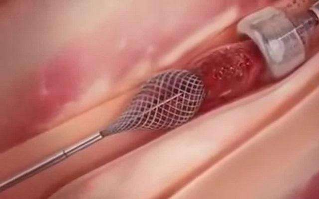 急性心肌梗死另一方面,技术并不普及,连溶栓很多医院都不敢溶,取栓更