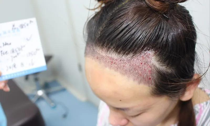 小仙女大额头植发1850单位,术后12月每月图片都晒出来