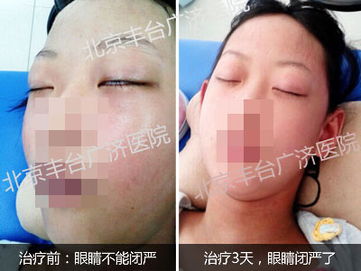 甲亢突眼:中医治疗3天眼睛可以闭严了