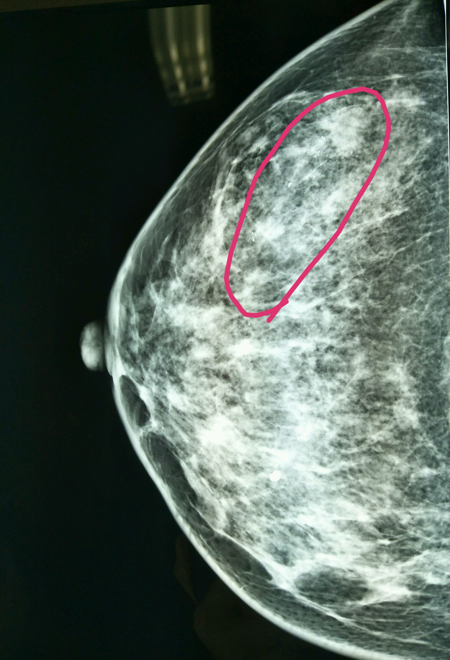 又是一例比较典型的乳腺癌