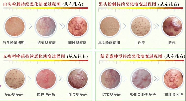 青春痘疤痕痤疮疤痕分为