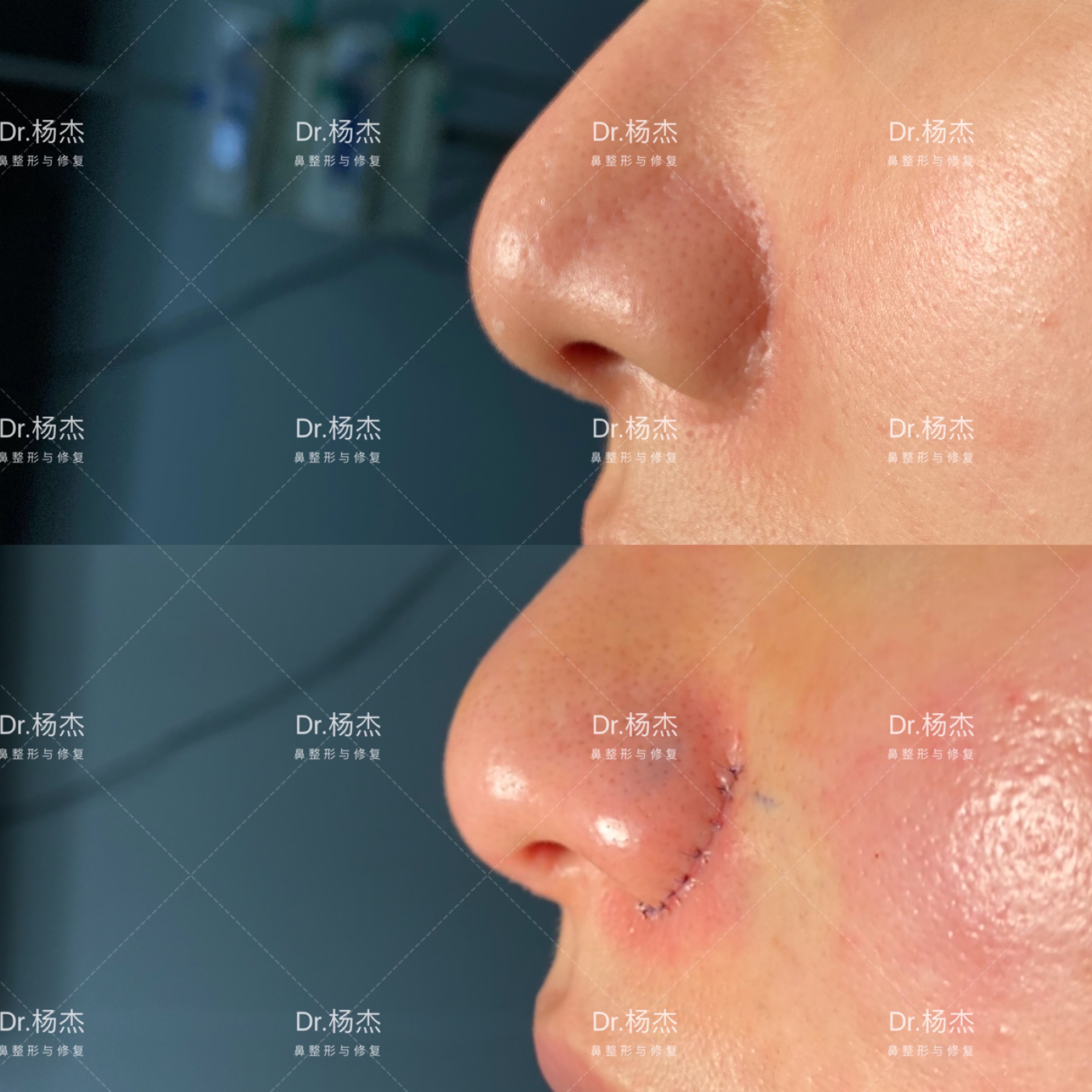 面部凹陷性疤痕修复（自体脂肪填充1次+3次点阵激光+1次手术切缝） - 知乎