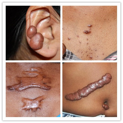 如何判断是疤痕疙瘩?它有哪些危害?