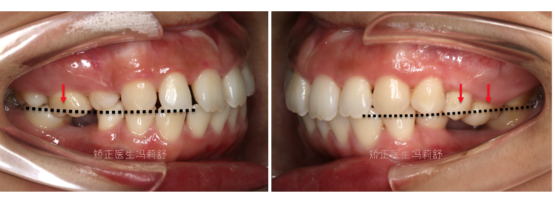 缺失牙对合的向缺隙处牙齿伸长还有,缺失牙齿侧咀嚼效率越多越少会