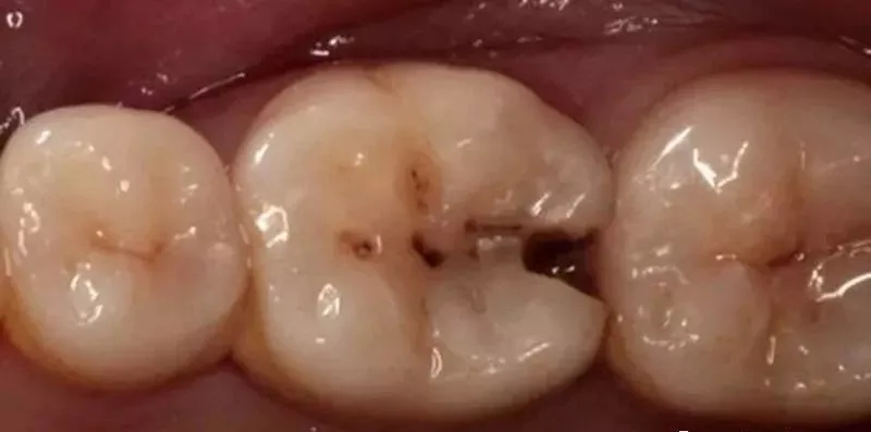 总是塞牙缝原因是什么