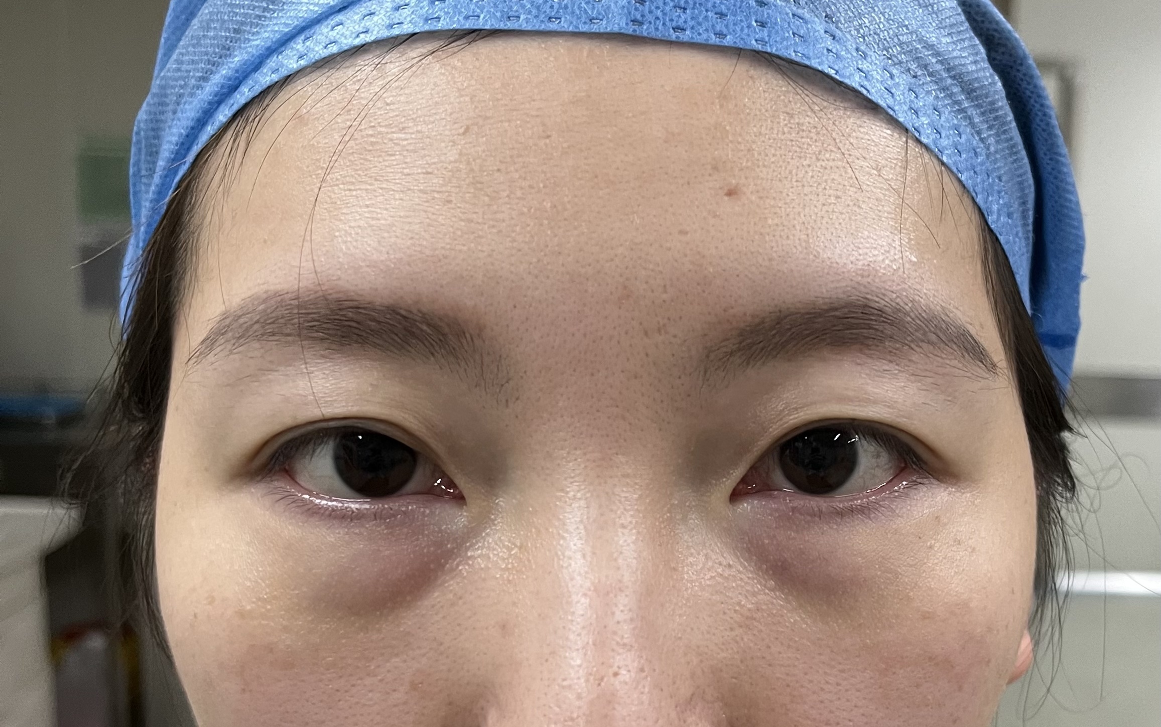杭州眼窝凹陷脂肪填充+双眼皮开眼角案例 - 知乎