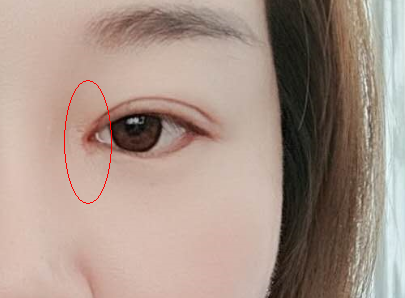 这里所说的开眼角常指的是开内眼角,开内眼角手术需要切开内眦角,只要