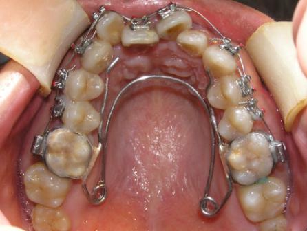 牙医口中的片切,扩弓,拔牙,磨牙远移,到底是什么