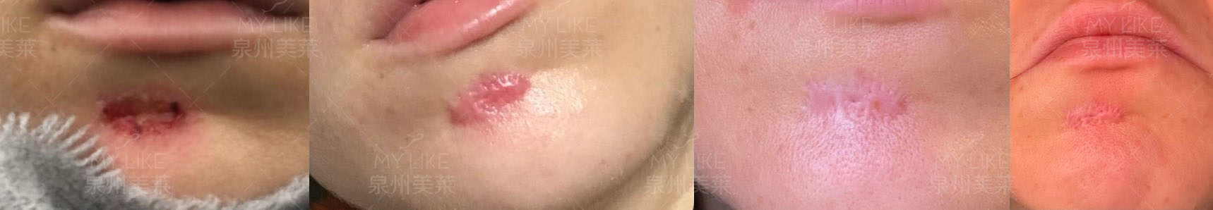 下巴增生性瘢痕，我想切除这个疤痕可以吗?-张小路执业医师-爱问医生