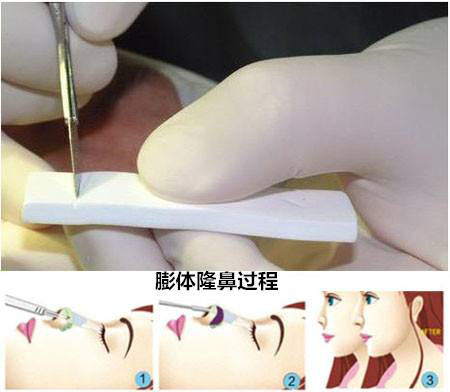 假体隆鼻的材料要怎么选?