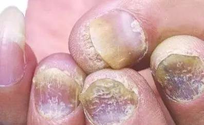 指甲变脆易碎可能是灰指甲