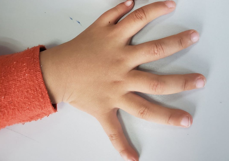 什么是镜影手畸形镜影手畸形的最佳手术时间是什么时候