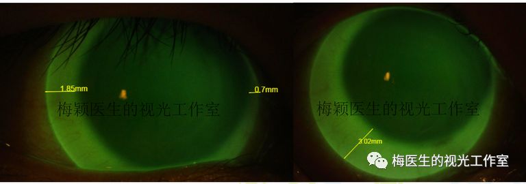探秘儿童近视控制的新工具多焦接触镜之软性多焦接触镜