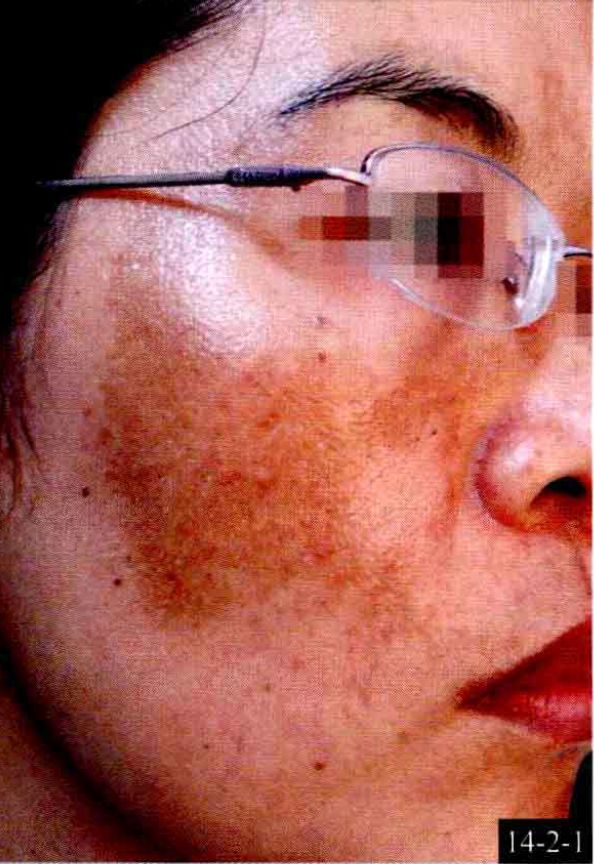 过敏性紫癜多发生于儿童和青少年,可反复发作.