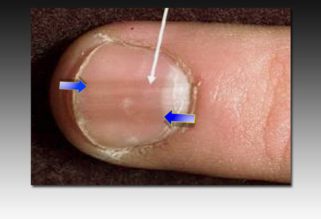 指甲里的秘密:指甲异常与身体疾病的亲密关系