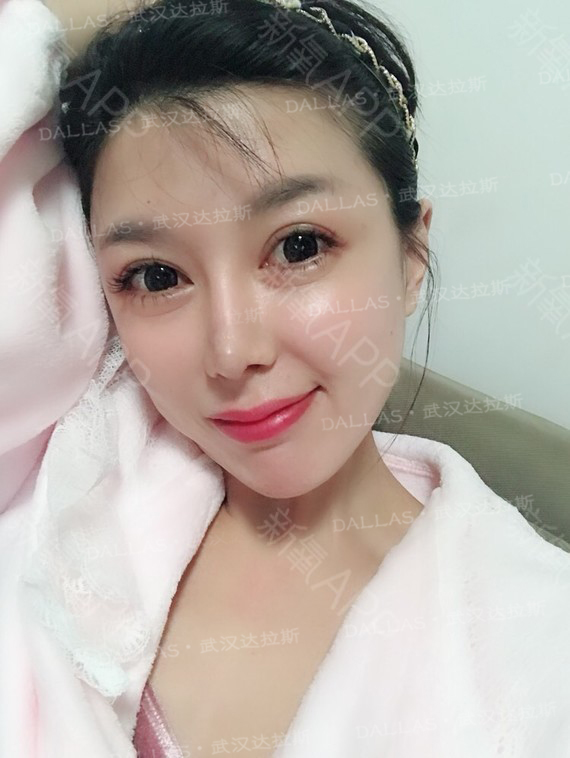 刘波全肋隆鼻修复466505天案例日记分享