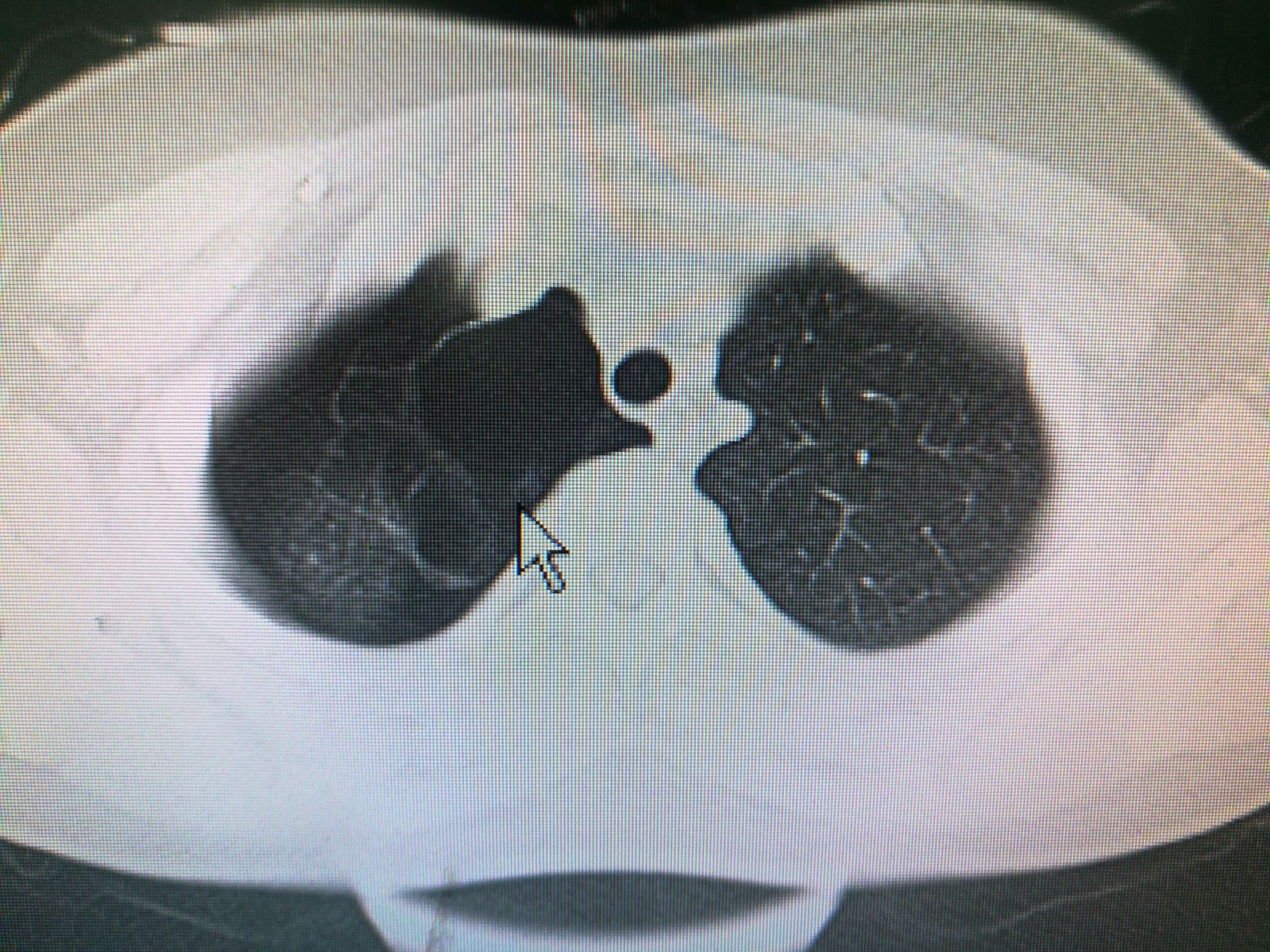 肺大泡的胸片图片图片