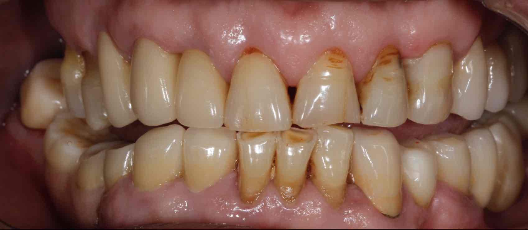 精密附着体修复失败牙槽骨严重萎缩再修复案例