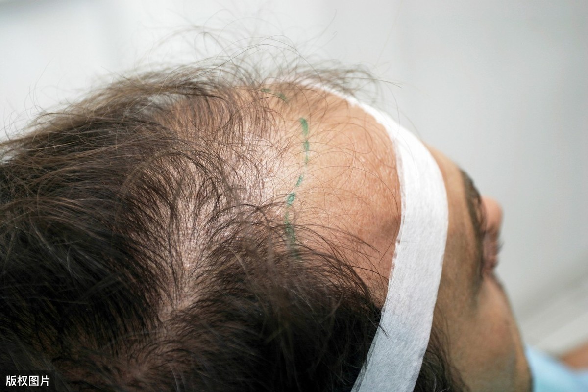 脱发严重,毛囊萎缩坏死后,为什么只能植发后再长?