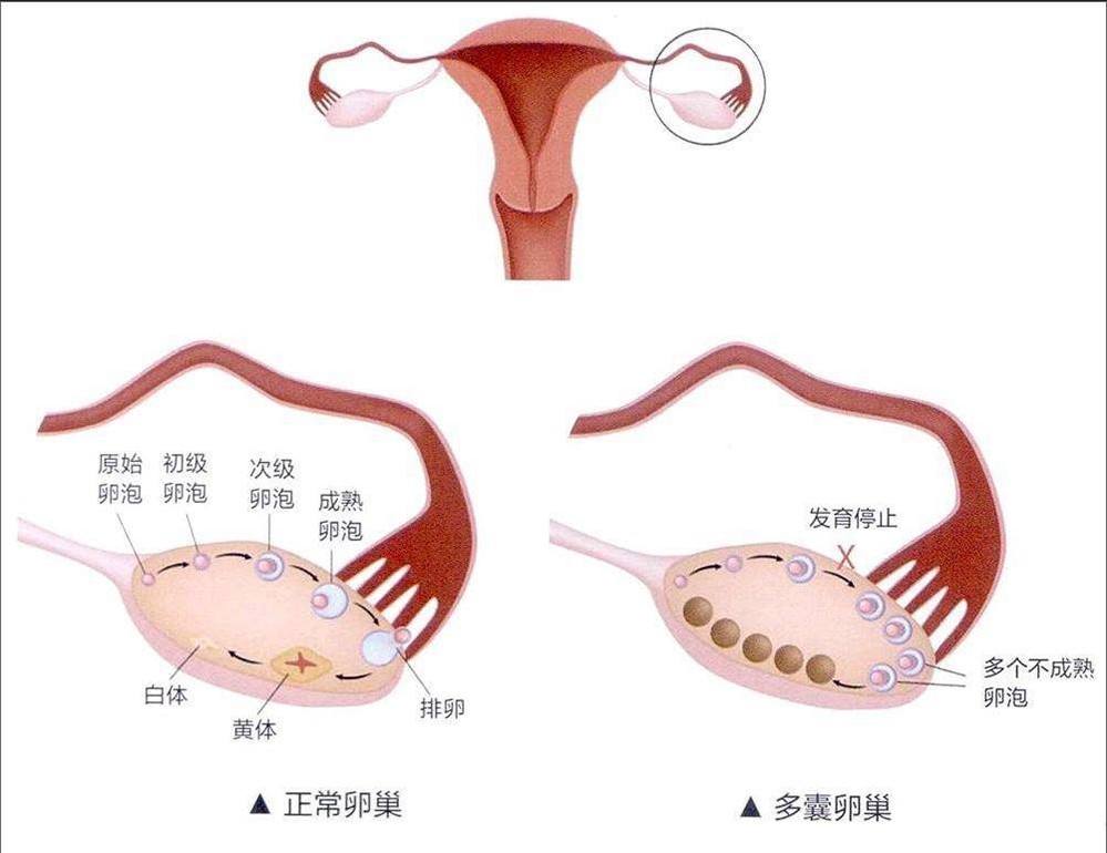 多囊卵巢能怀上孩子吗图片