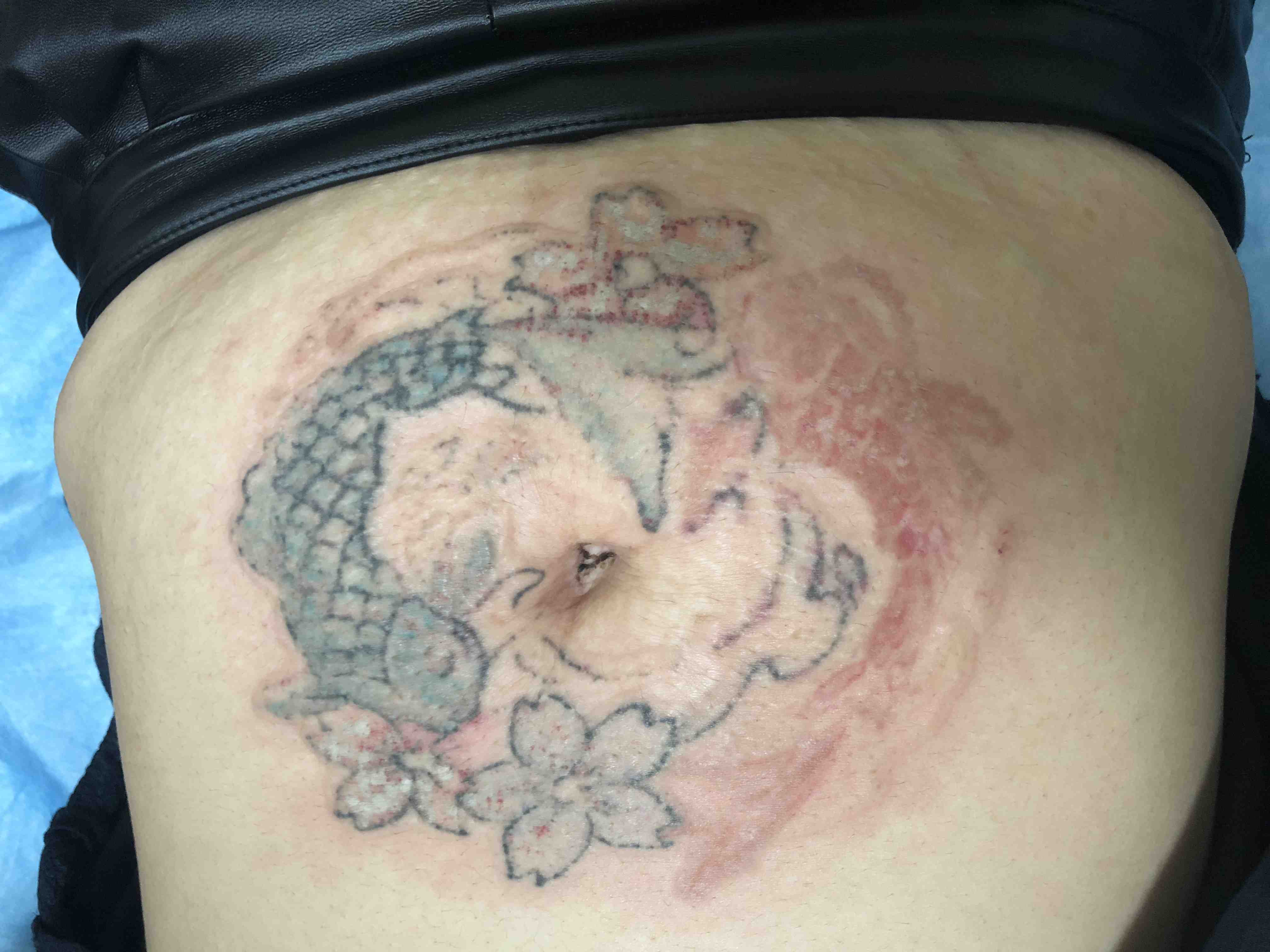 蜂巢皮秒和超皮秒激光洗纹身的优势