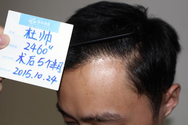年纪轻轻,就六七级脱发,为改善家人对的印象,植发2460单位