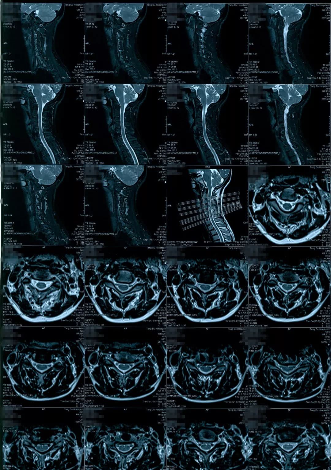 病例点评:神经根型颈椎病要不要做手术?-李维新副主任医师-爱问医生