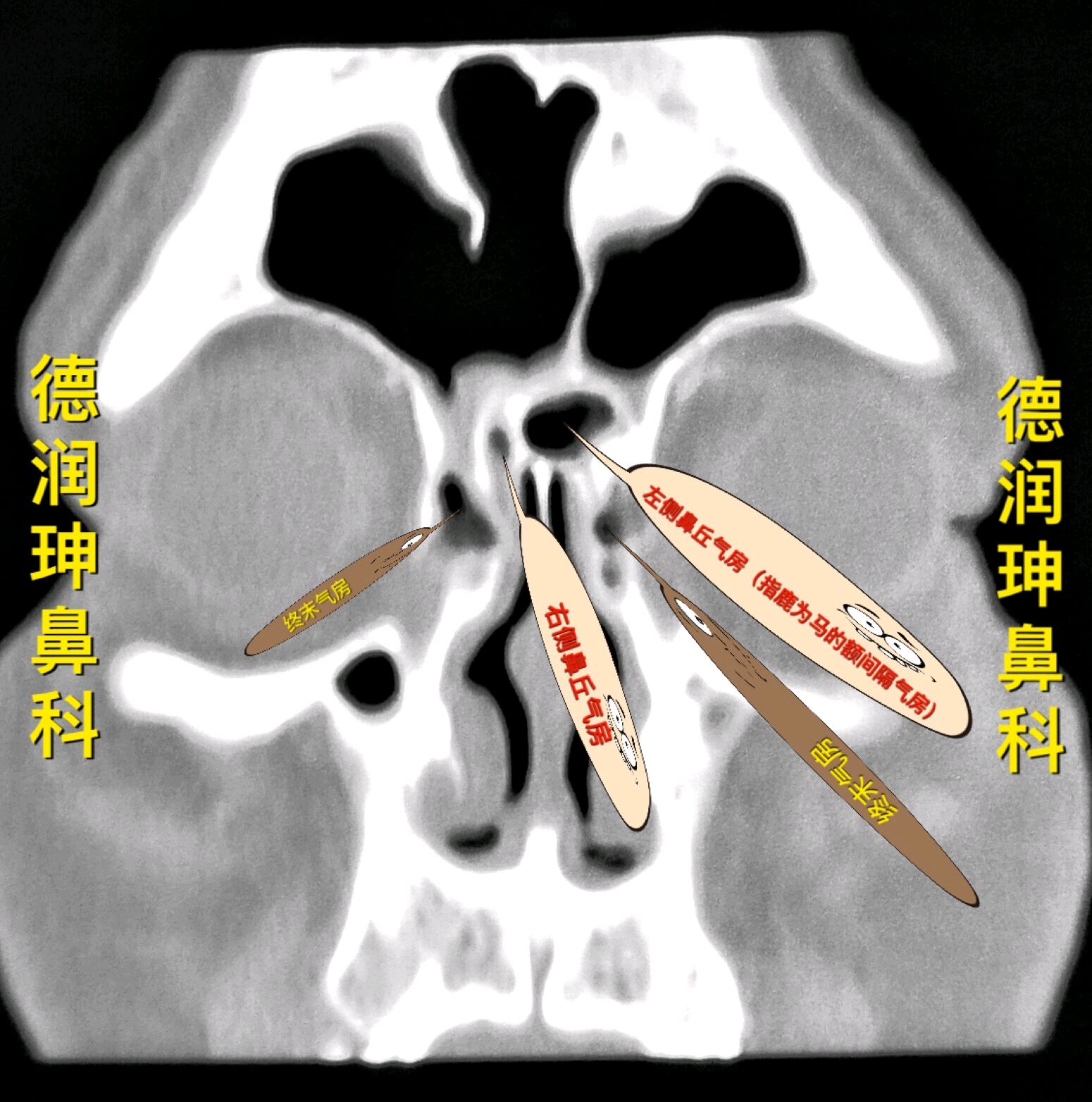 把额隐窝区域内的分割的气房弄得越复杂,越让手术医生无所适从,对安全