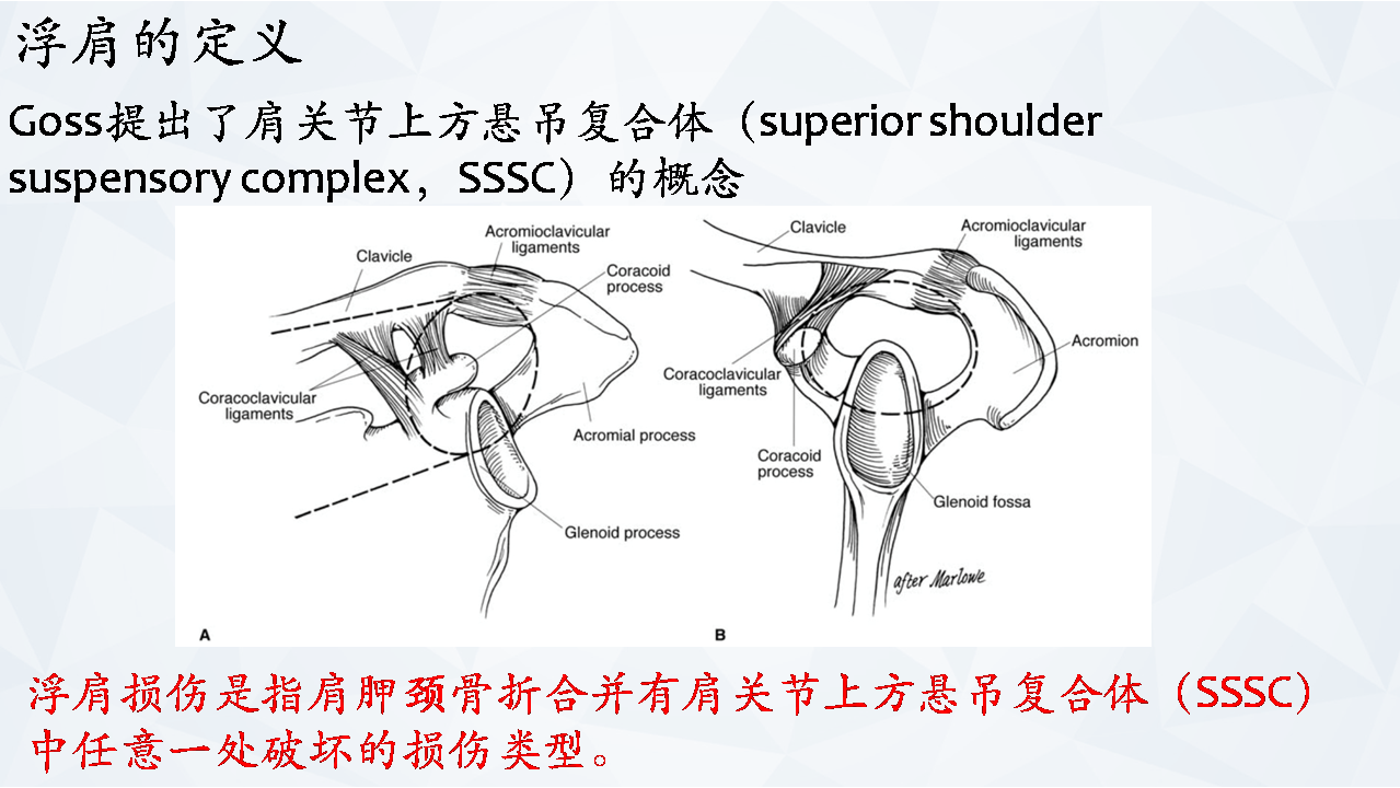 涨知识肩胛骨骨折分型