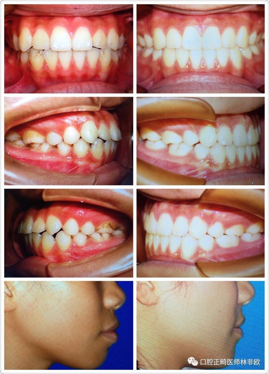 正畸矫治到底要多久?