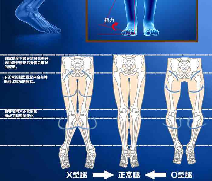 吸脂可以矫正先天o型腿效果好不好哦